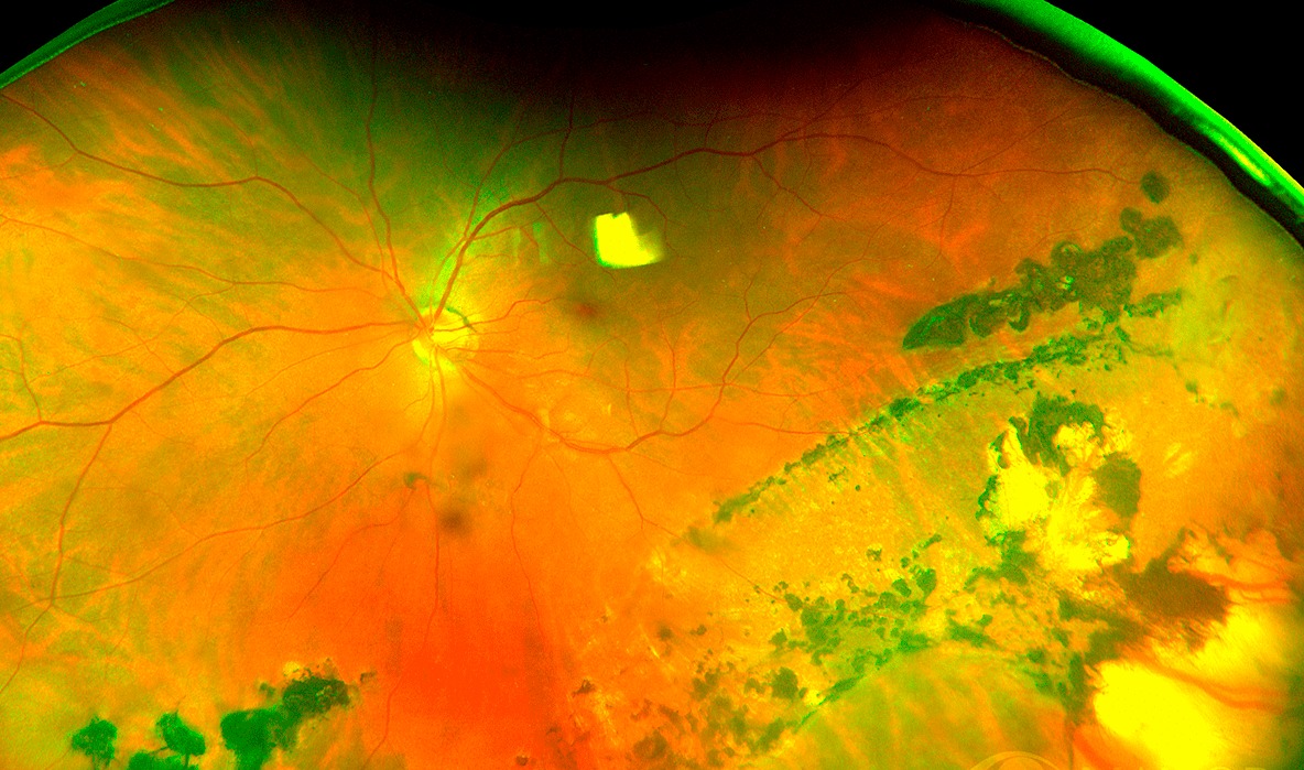 Desprendimiento de retina foto